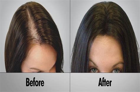 Nanomax is a two stage process that is applied to clean <b>hair</b>. . Best salon treatment for hair loss